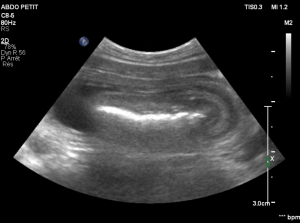 Echographie suspicion de boules de poils dans l'intestin